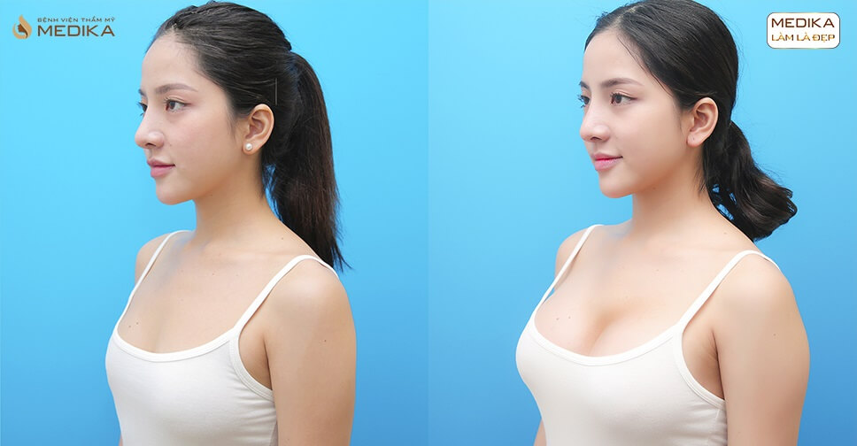 Phẫu thuật nâng ngực đẹp giúp cô nàng người mẫu thành công hơn - Kiến thức nâng ngực
