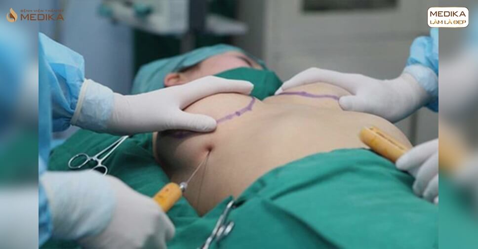 Biến chứng khủng khiếp sau phẫu thuật nâng vòng 1 - Kiến thức nâng ngực