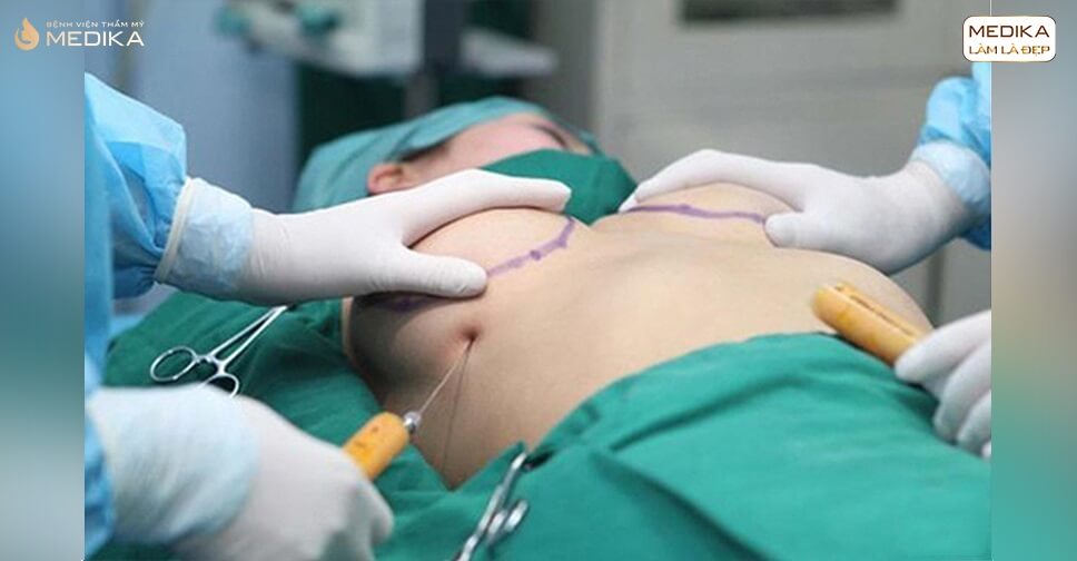 Phẫu thuật nâng vòng 1 nội soi - Phương pháp mới hết sức diệu kỳ - Kiến thức nâng ngực