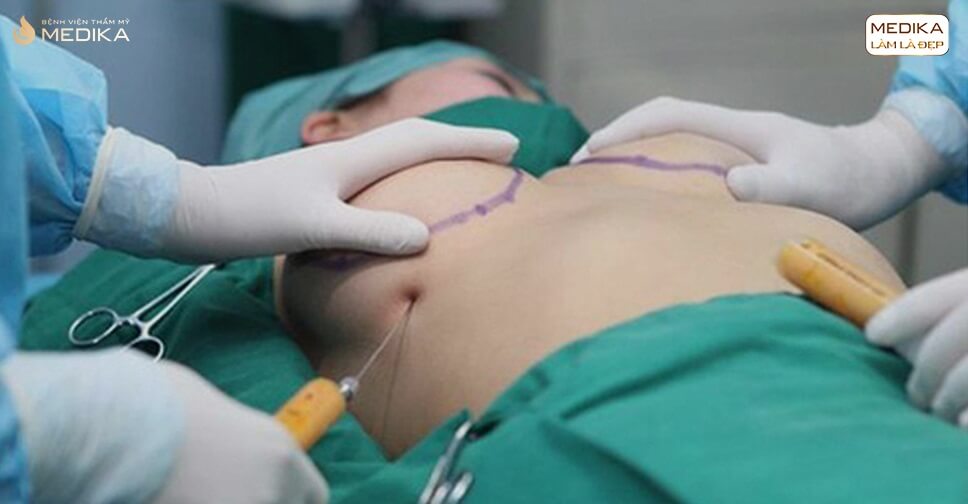 Phẫu thuật nâng vòng 1 nội soi phương pháp tiến tiến hàng đầu - Kiến thức nâng ngực