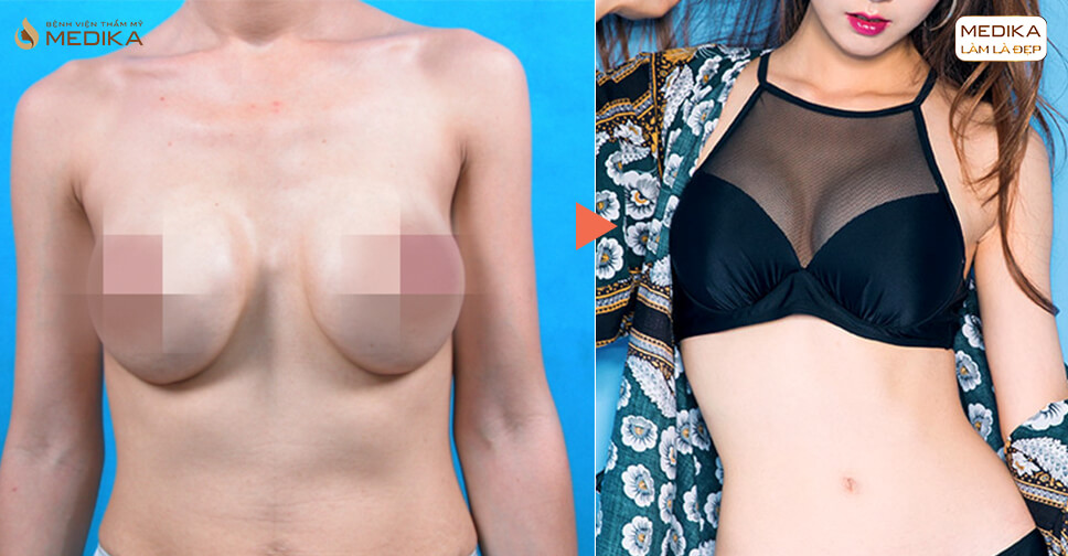 Cuối năm phẫu thuật ngực hỏng nhiều vì khách ham khuyến mãi từ Kiến thức nâng ngực